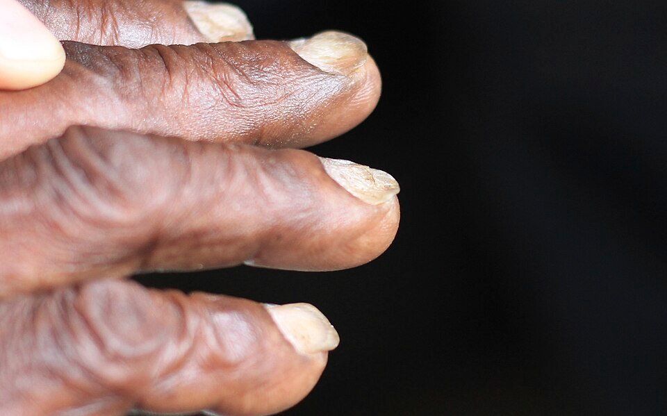 Spoon-shaped nails (koilonychia), one of the less common anemia symptoms of iron deficiency