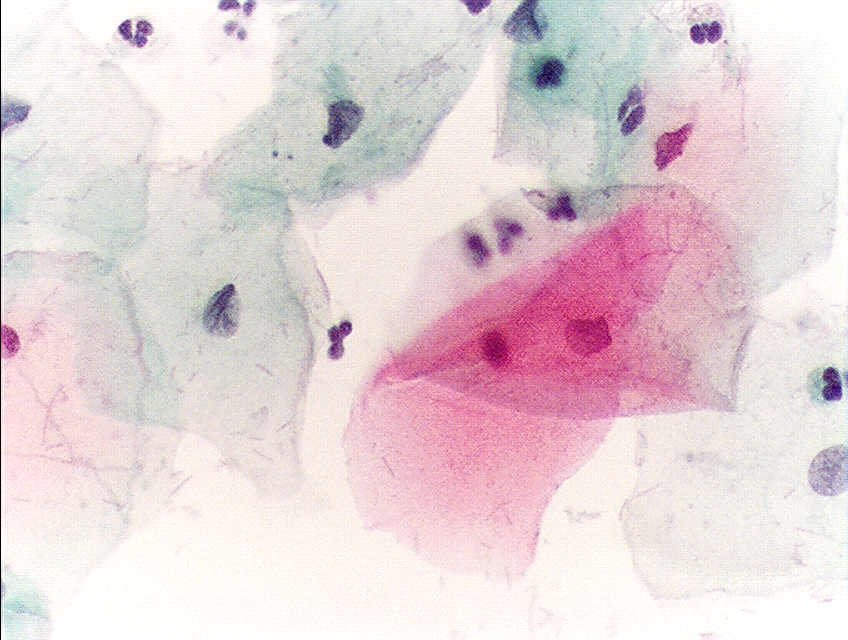 Normal cervical cells on a Pap test, the screening test that can find changes before cervical cancer symptoms appear