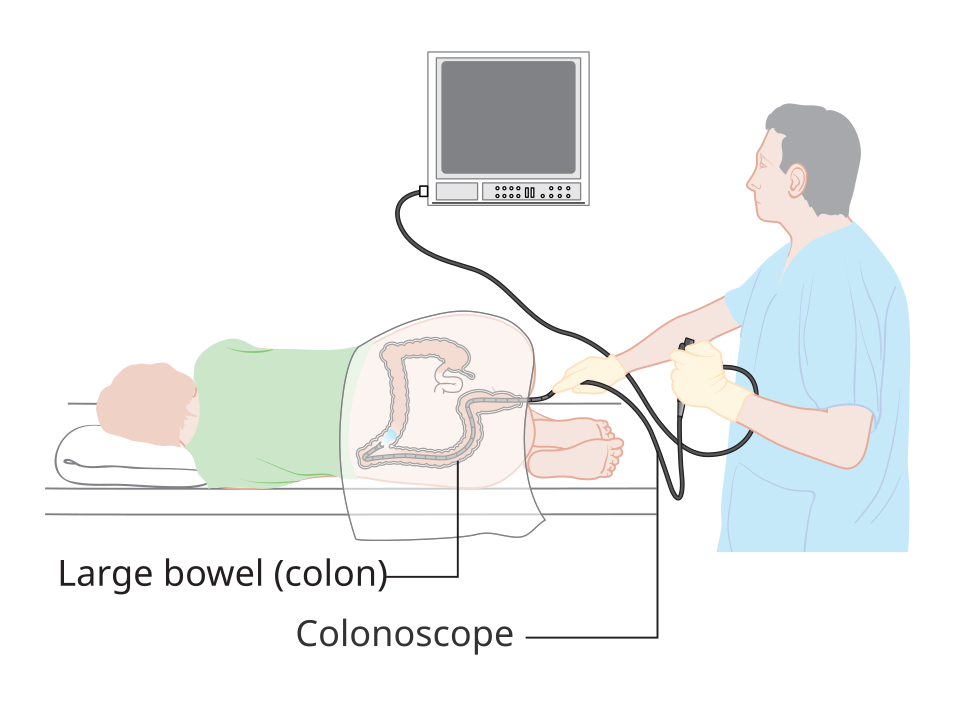 Diagram of a colonoscopy, the main test used to investigate colon cancer symptoms
