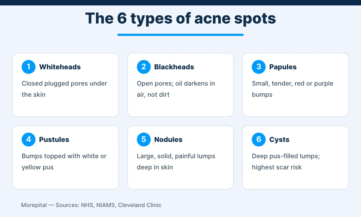 Infographic of the six types of acne spots: whiteheads, blackheads, papules, pustules, nodules and cysts