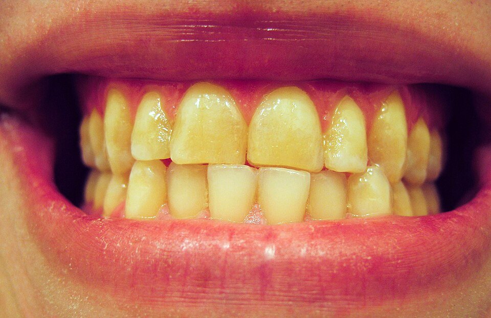 Close-up of front teeth worn short and flat by long-term teeth grinding