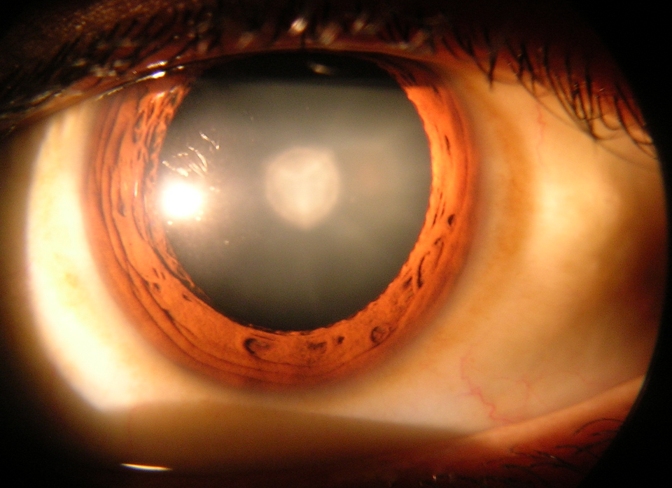 Close-up of a human eye with a cataract, showing a cloudy white lens behind the pupil