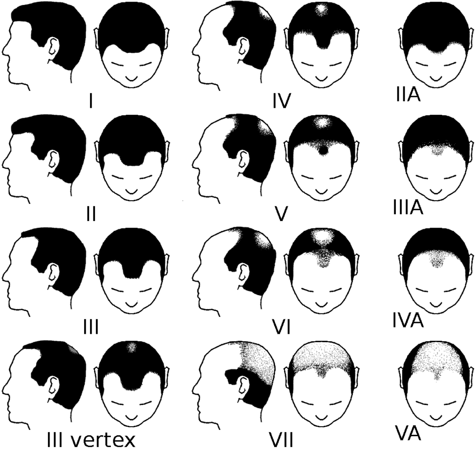 Diagram of the Norwood scale showing stages of male pattern baldness