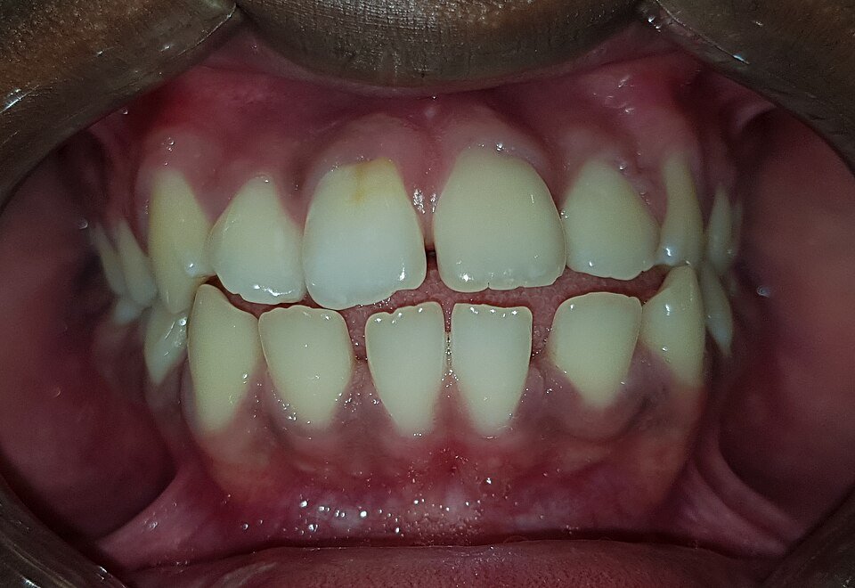 Close-up of teeth with an anterior open bite, where the upper and lower front teeth do not meet