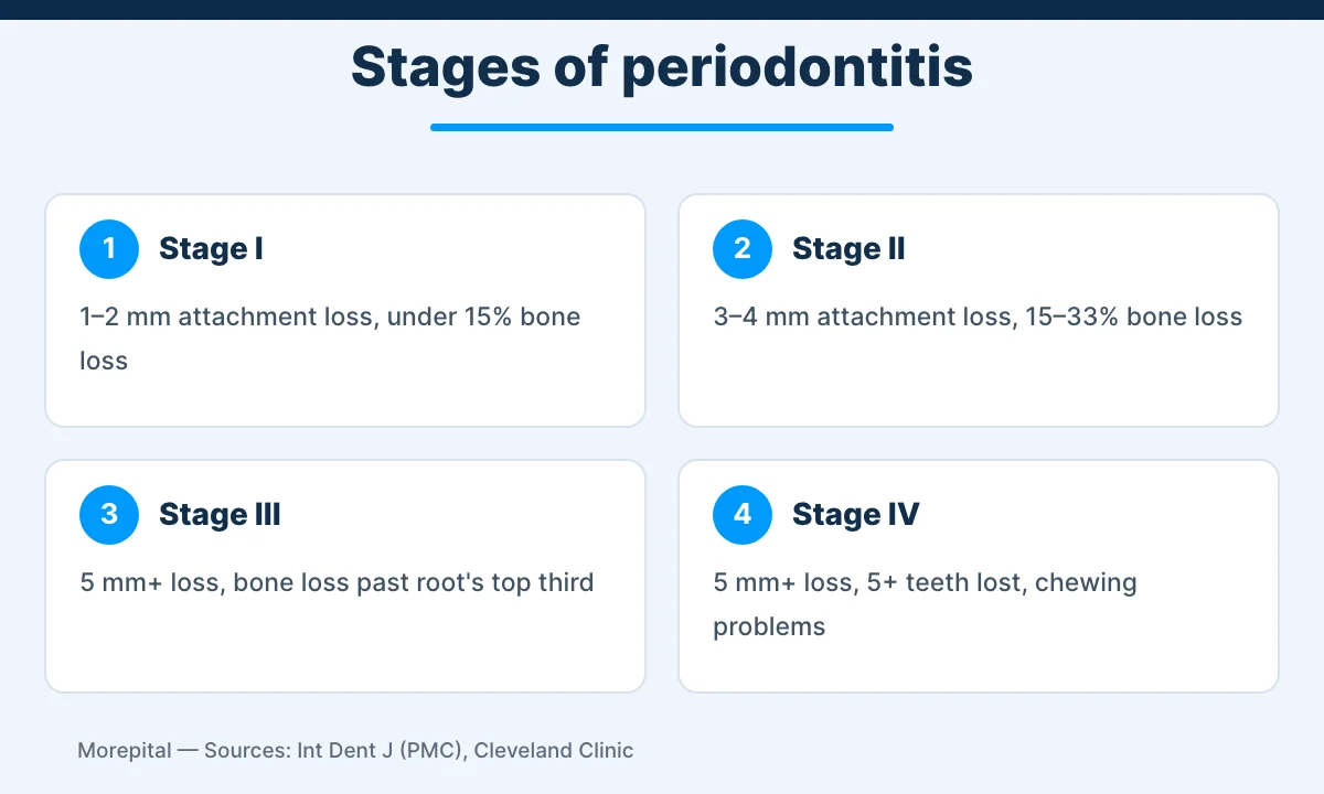Infographic showing the four stages of periodontitis by attachment loss, bone loss and tooth loss