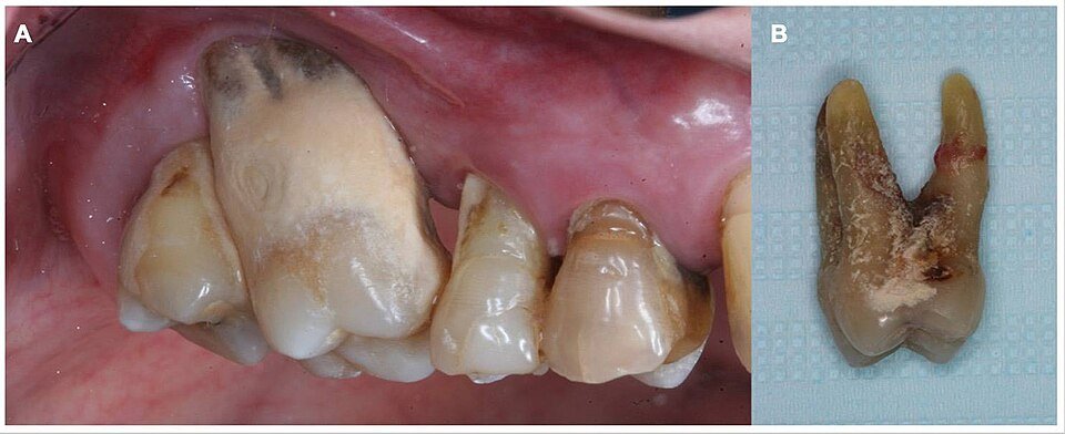 Teeth of a patient with chronic periodontitis showing tartar, gum recession and attachment loss, next to an extracted molar