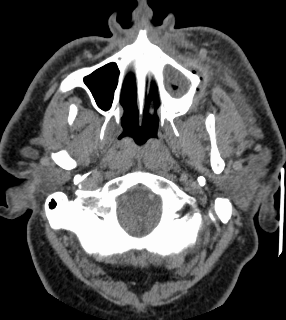 Axial CT scan of the face showing a dental infection with an abscess and inflammation of the maxillary sinus