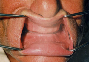 Clinical photo of an edentulous upper and lower jaw with the lips held open by retractors
