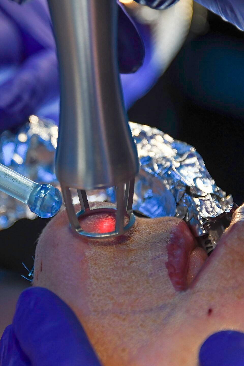 Close-up of CO2 laser skin resurfacing being performed on facial skin to treat wrinkles