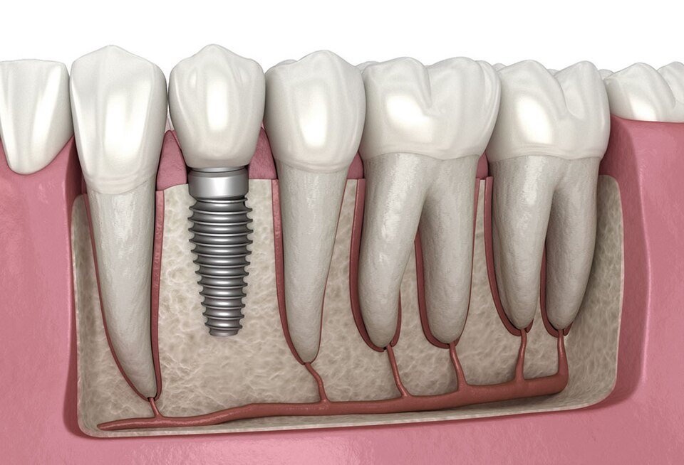 Dental implants in Turkey: 3D illustration of a dental implant post, abutment and crown next to natural teeth