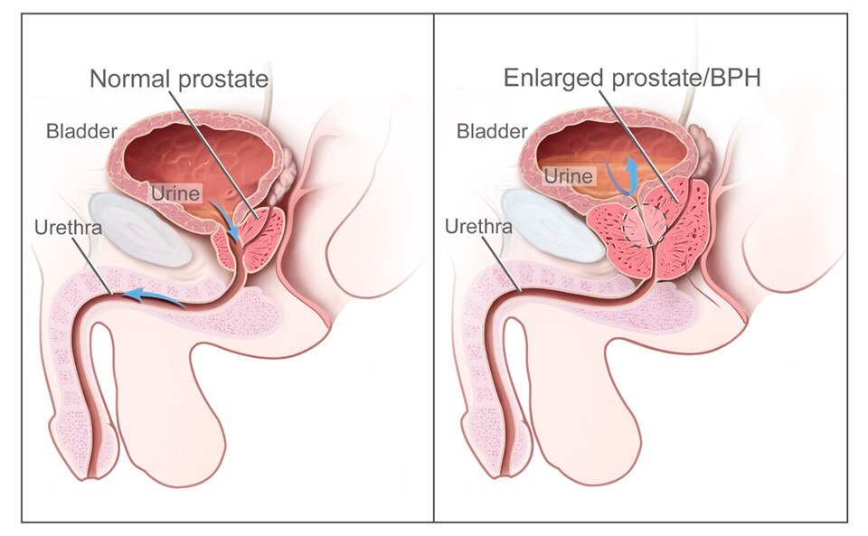 Diagram of a normal prostate compared with an enlarged prostate pressing on the bladder and urethra