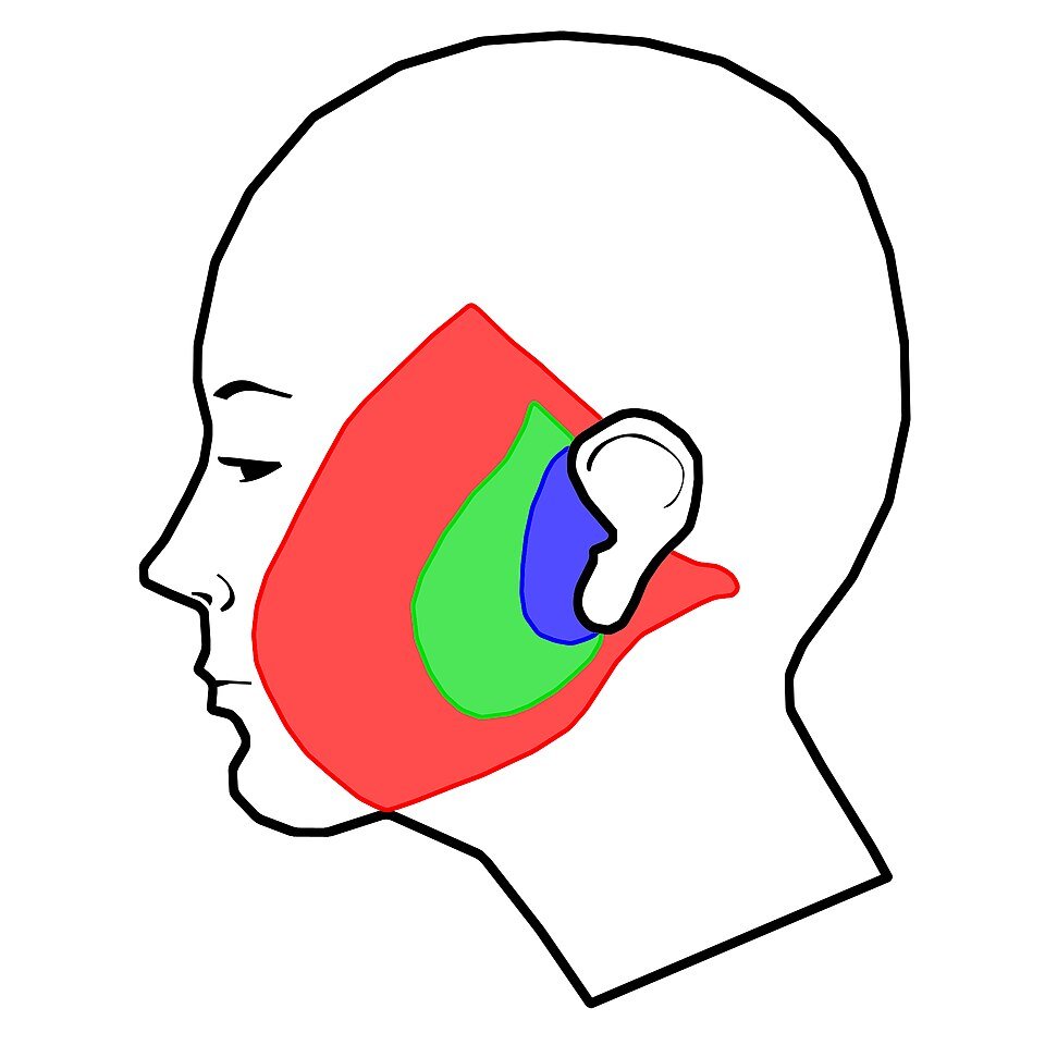 Facelift in Turkey diagram of incisions and skin undermining used in different facelift techniques