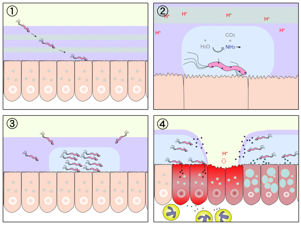 Diagram of how H. pylori infection leads to a stomach ulcer