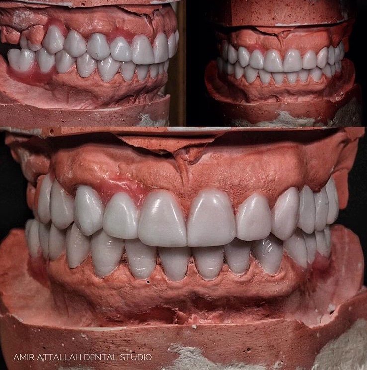 Hollywood smile in Turkey planning: a wax mock-up used to plan new front teeth
