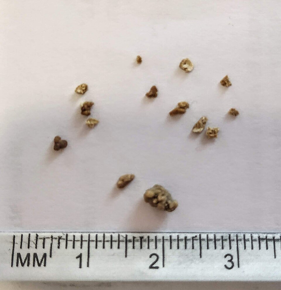 Kidney stones: one whole stone and fragments of another after shock wave lithotripsy