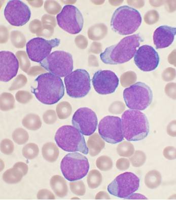 Bone marrow smear of acute lymphoblastic leukemia, the blood cancer behind many leukemia symptoms