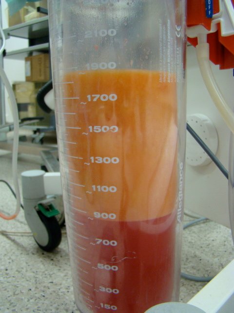 Liposuction in Turkey: fat tissue and tumescent fluid collected during a liposuction procedure