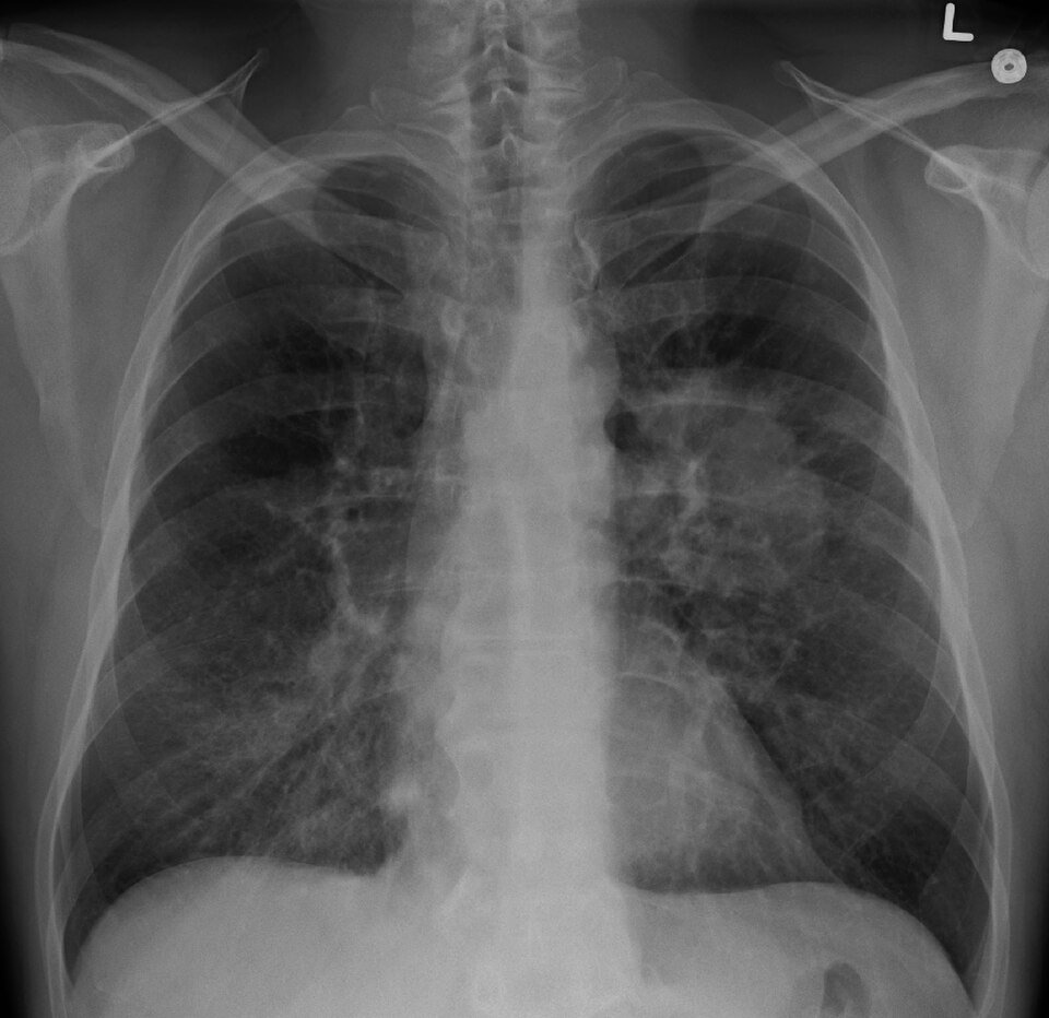 Chest X-ray showing a lung tumor, a common first test for lung cancer symptoms