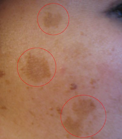 Melasma on the cheek: circled flat brown patches of facial hyperpigmentation