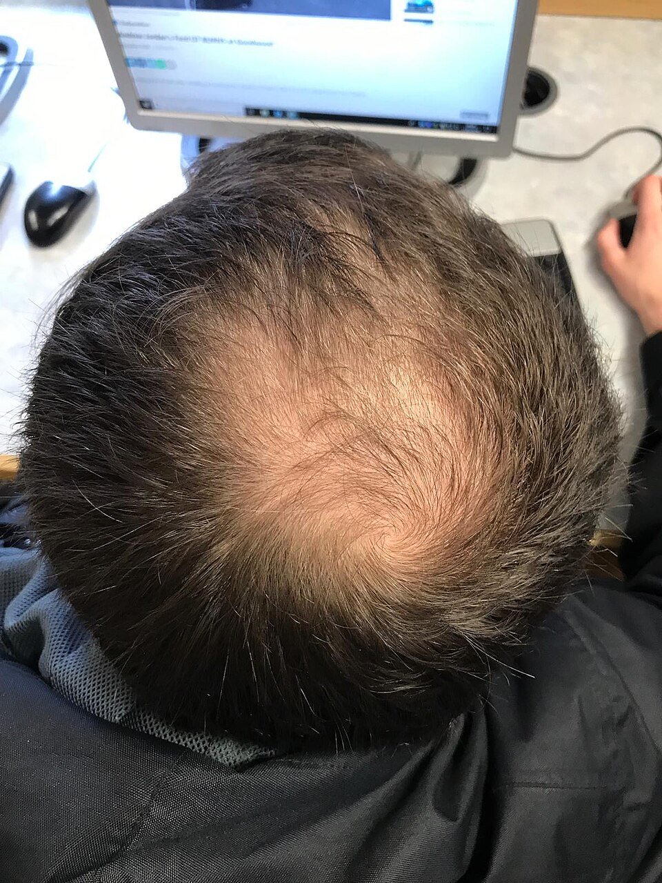Scalp with male pattern hair loss on the crown, a common area treated with minoxidil for hair loss