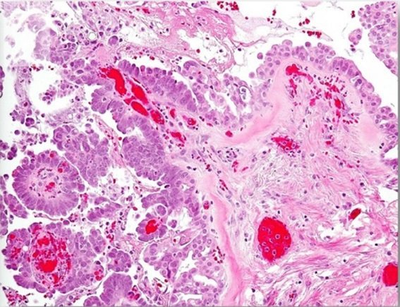 Microscope view of high-grade serous carcinoma, the ovarian tumor type behind many ovarian cancer symptoms