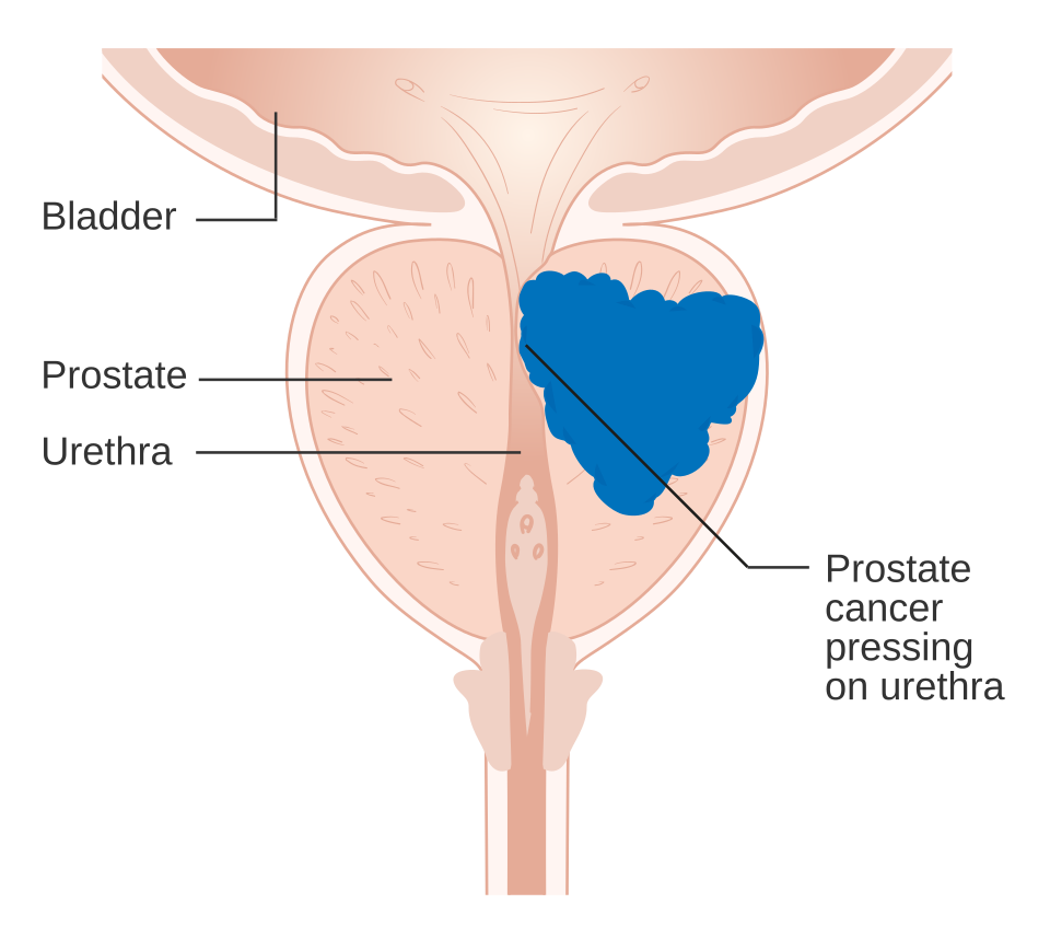 Diagram of prostate cancer pressing on the urethra, a cause of urinary prostate cancer symptoms