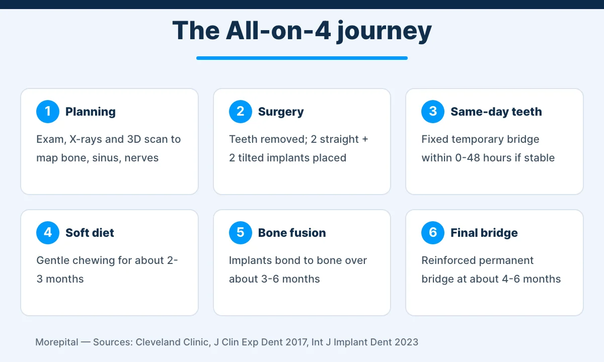 Six-step infographic of All-on-4 dental implant treatment from planning to the final fixed bridge