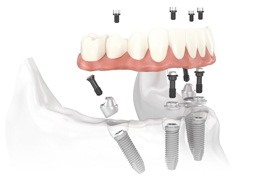 3D illustration of a lower jaw with two straight front implants and two tilted back implants holding a full-arch bridge