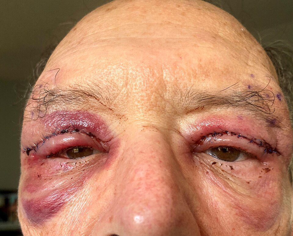 Close-up of a patient's eyes one day after upper blepharoplasty, with stitches in both eyelid creases and bruising around the eyes
