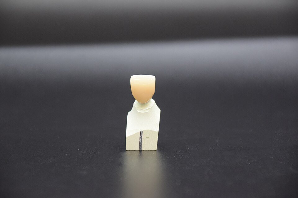 A single tooth-colored ceramic crown for a front tooth sitting on a laboratory stone model