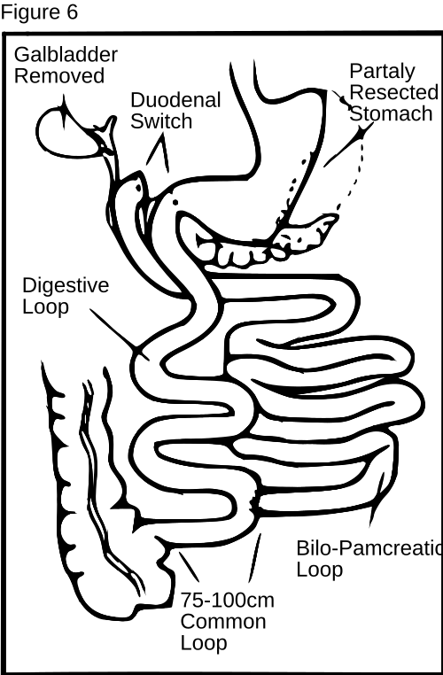 Diagram of a sleeve gastrectomy showing the narrow remaining stomach tube
