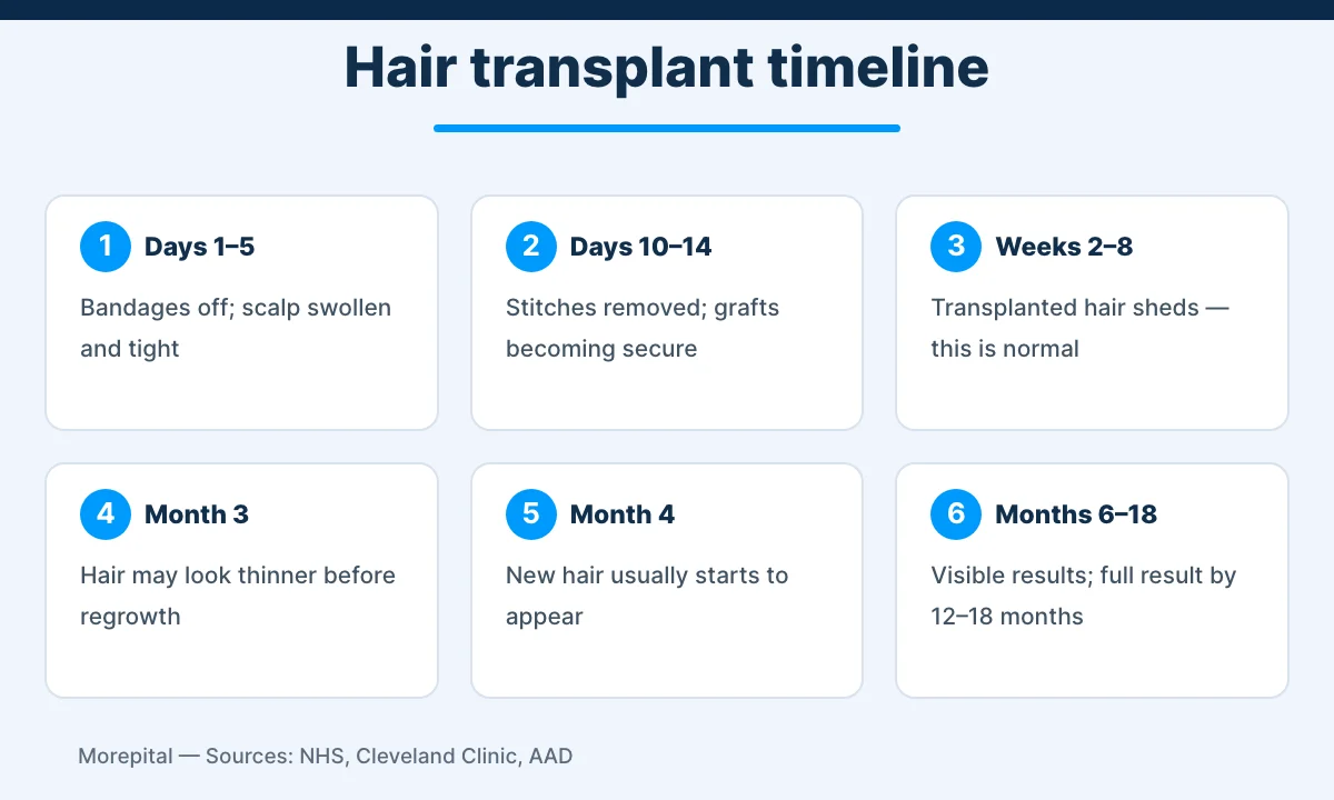 Hair transplant recovery timeline from day 1 to 18 months