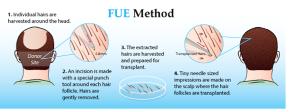 Diagram of the FUE hair transplant method from donor harvesting to implantation