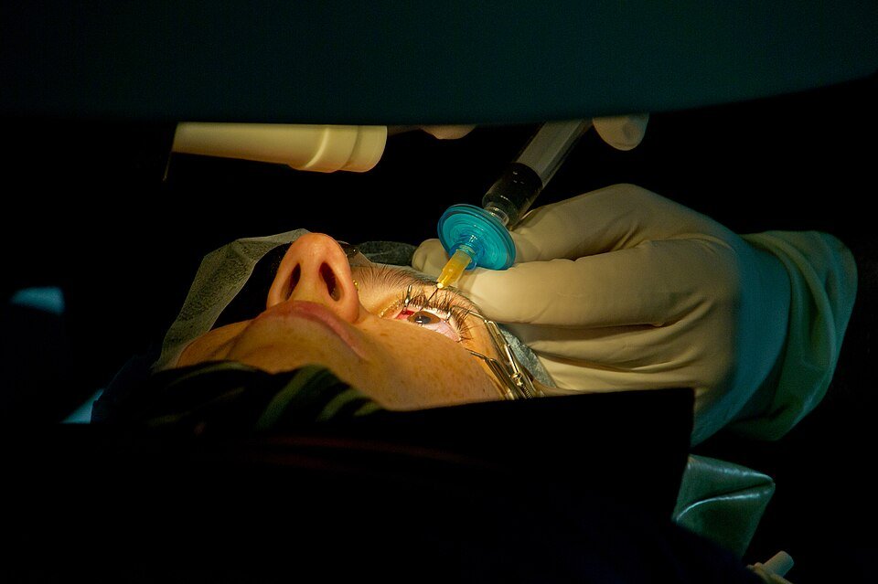 Patient lying under an excimer laser during LASIK eye surgery