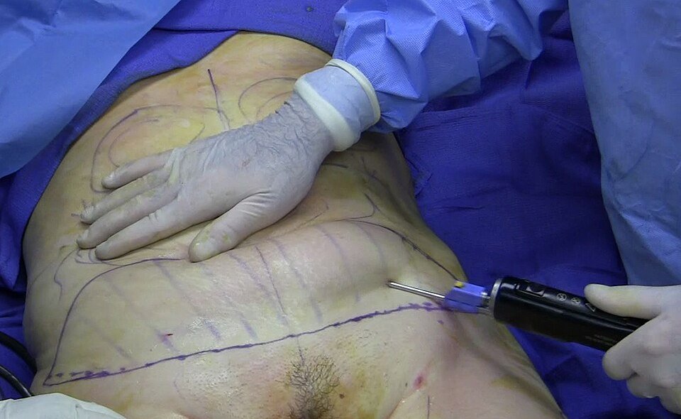Surgeon using a cannula to remove fat during power-assisted liposuction
