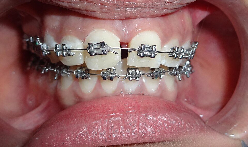 Close-up of upper and lower teeth fitted with metal orthodontic braces, brackets joined by an archwire