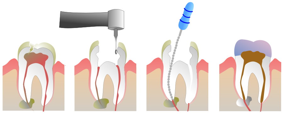 Diagram of root canal treatment on a molar: opening and cleaning the infected pulp, shaping the canals with a file, then filling the canals and placing a crown
