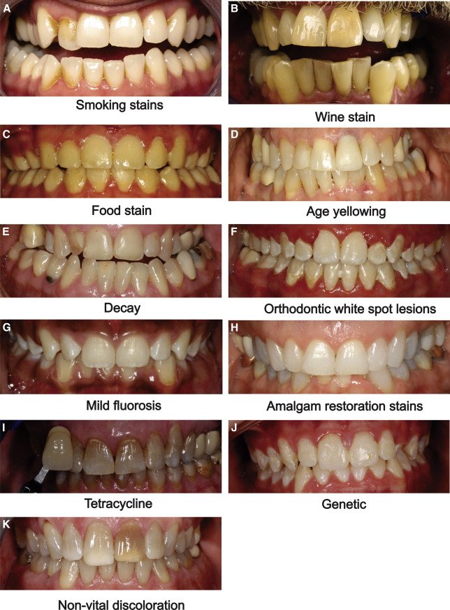 Clinical photos of extrinsic tooth stains from smoking, wine and food, and intrinsic stains such as age yellowing and decay