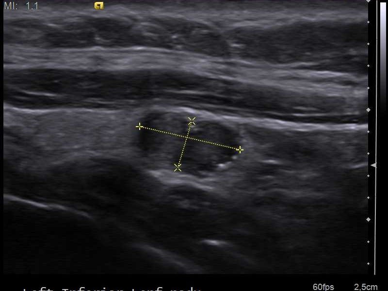 Ultrasound of papillary thyroid carcinoma with a calcified lymph node, a cause of thyroid cancer symptoms such as a neck lump