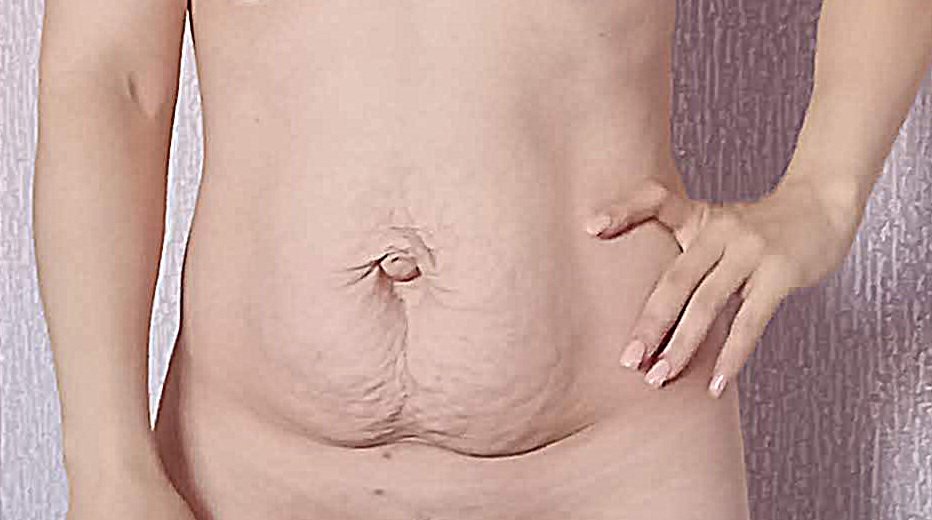 Tummy tuck in Turkey candidate: abdomen with loose skin, stretch marks and diastasis recti after pregnancy