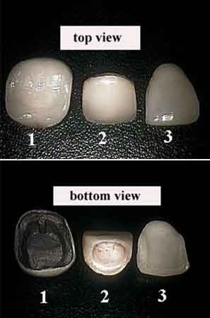 Veneers in Turkey: porcelain-metal crown, all-porcelain crown and porcelain veneer compared