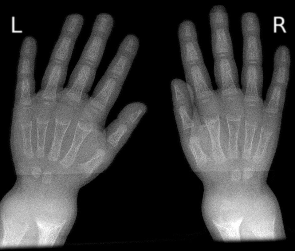Wrist X-ray showing rickets caused by severe vitamin D deficiency in a child